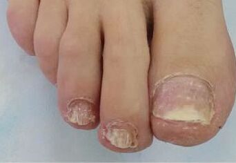 Nail fungus caused problems. 