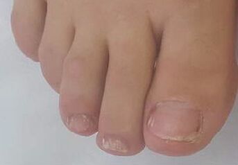 Promicil cured advanced onychomycosis