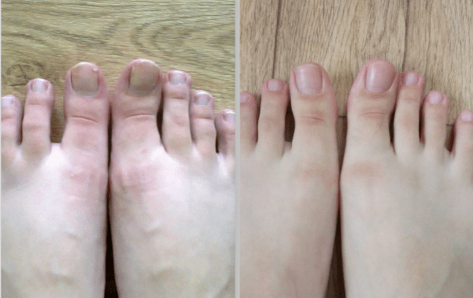 Before and after treatment for toenail fungus. 