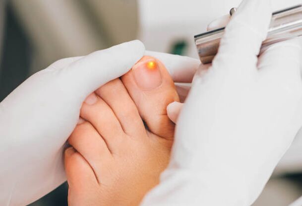 Laser treatment for toenail fungus. 