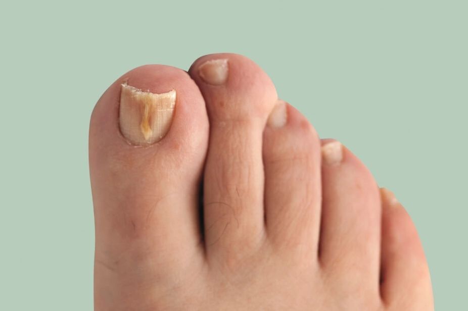 nail fungus symptoms