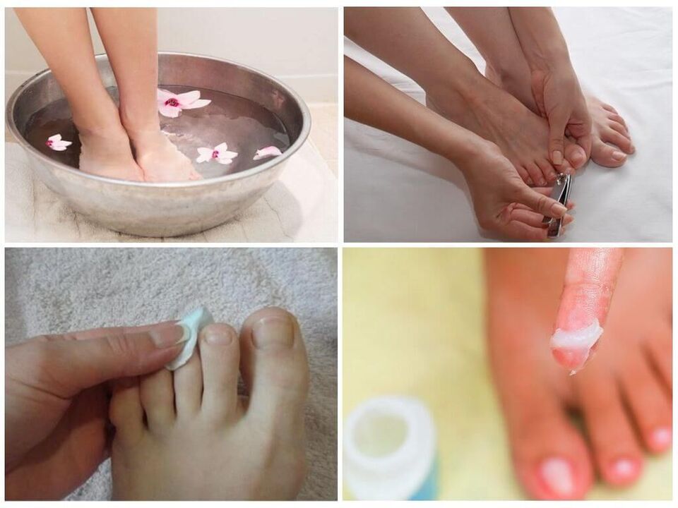 nail fungus treatment