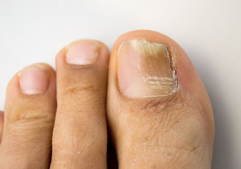 big toe nail fungus