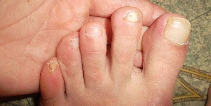 Why are nail fungus dangerous 