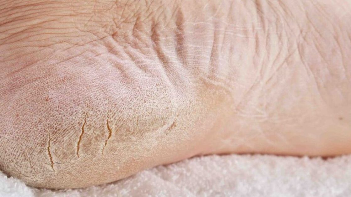 foot fungus infection