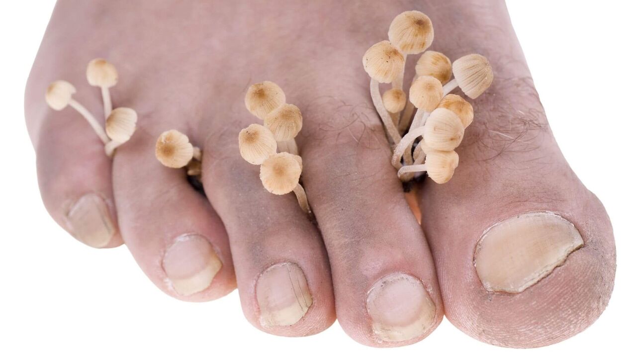 fungal infection on human feet