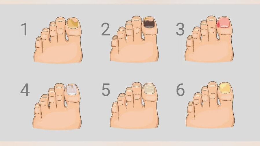 main signs of foot fungus