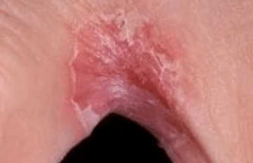 Leg fungus between the fingers