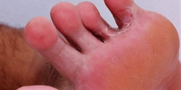 The fungus in the legs