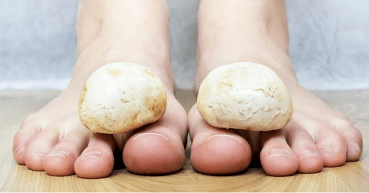 Quick Treatment of Fungi in the legs at home