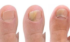 Stages of fungus development on the thumb