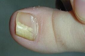 The reasons for the appearance of the fungus on the thumb