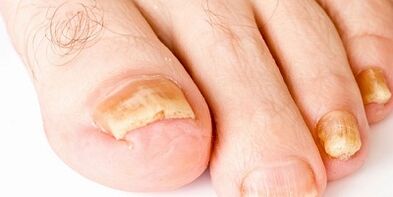 How and how to cure nail fungus