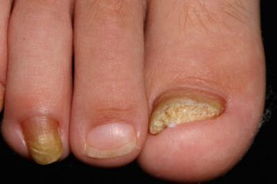 Leg nail mycosis