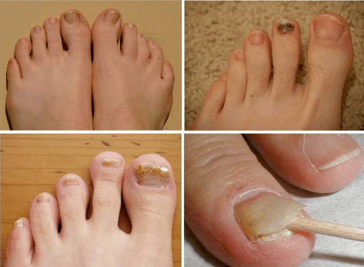 Nail fungus signs