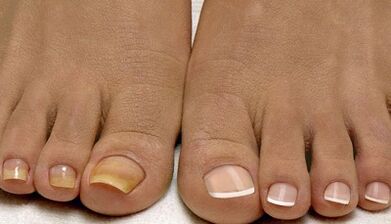The causes of the appearance of fungus on the nails