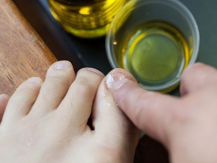 Apply medicated oil to nails affected by fungus.