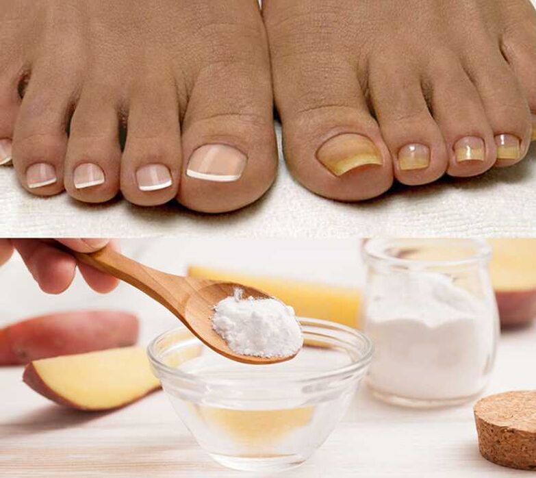 Soda to treat nail fungus.