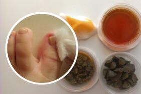 Treatment of toenail fungus with home remedies.