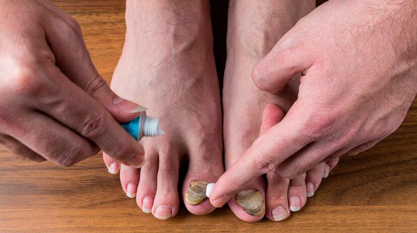 Apply antifungal cream on toenails to treat onychomycosis